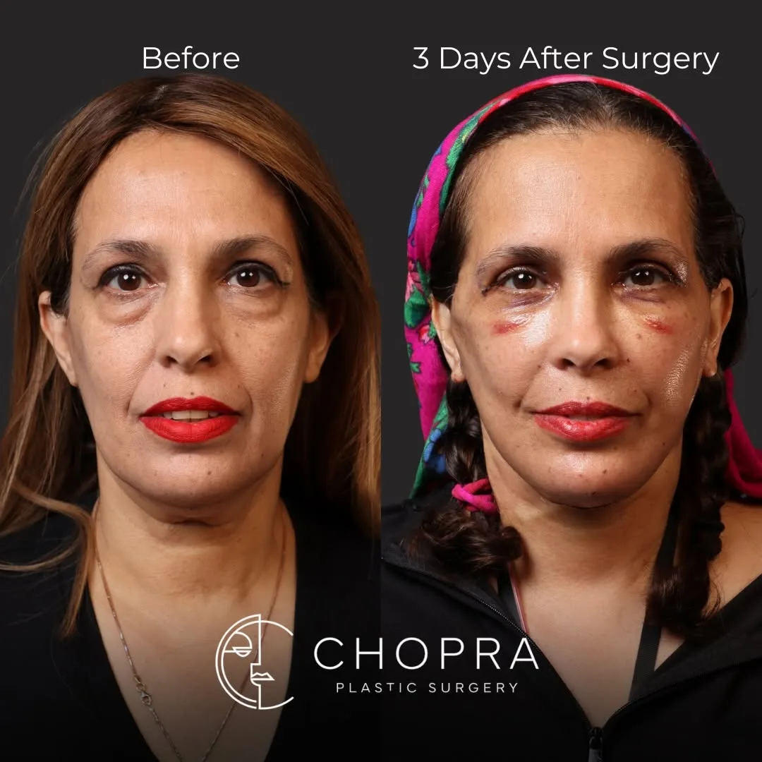 Before and after deep plane facelift — 58-year-old woman, frontal view by Dr. Karan Chopra