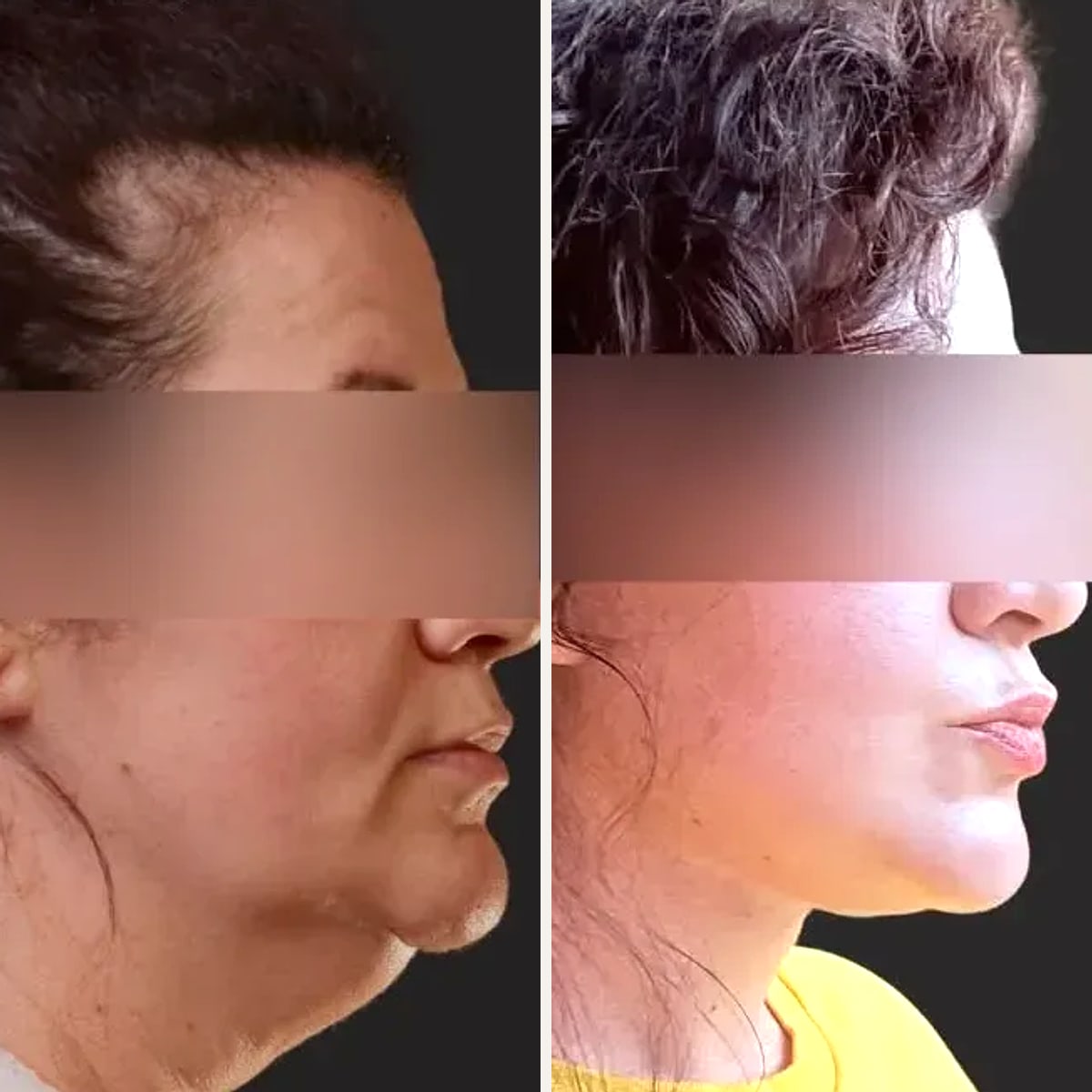 Before and after, Deep Plane Facelift