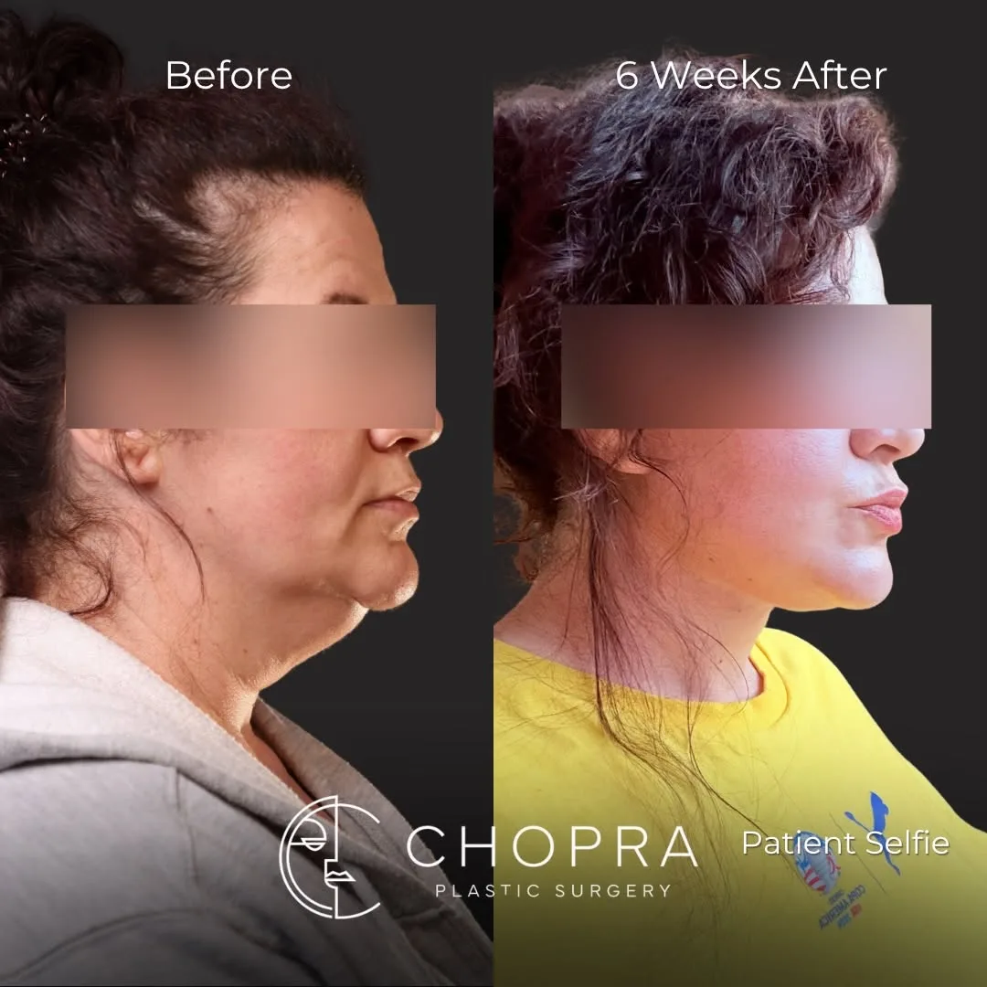 Before and after deep plane facelift — 41-year-old woman, left profile view, 6mo post-op by Dr. Karan Chopra