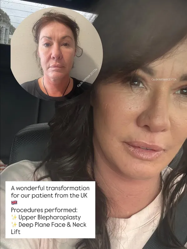 Before and after — Dr. Kayhan Zeytin