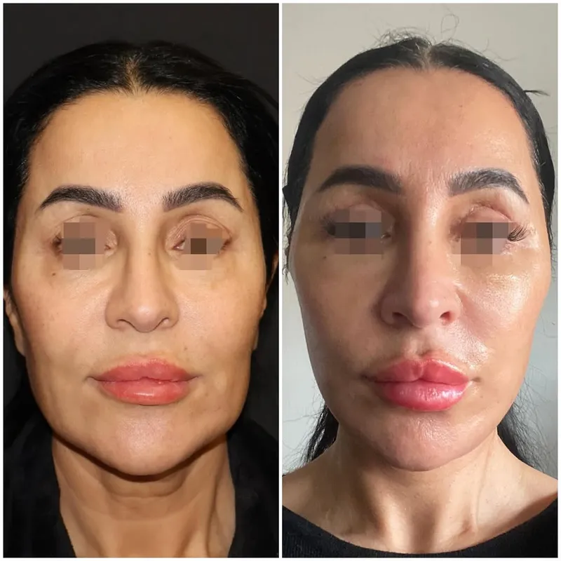 Before and after — Dr. Kayhan Zeytin