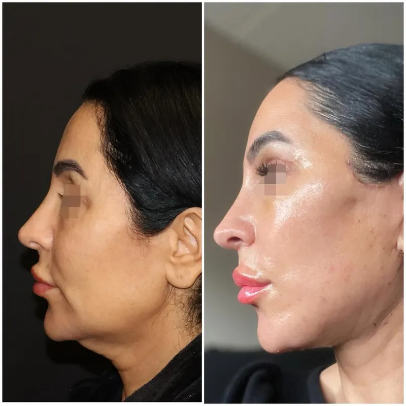 Before and after — Dr. Kayhan Zeytin