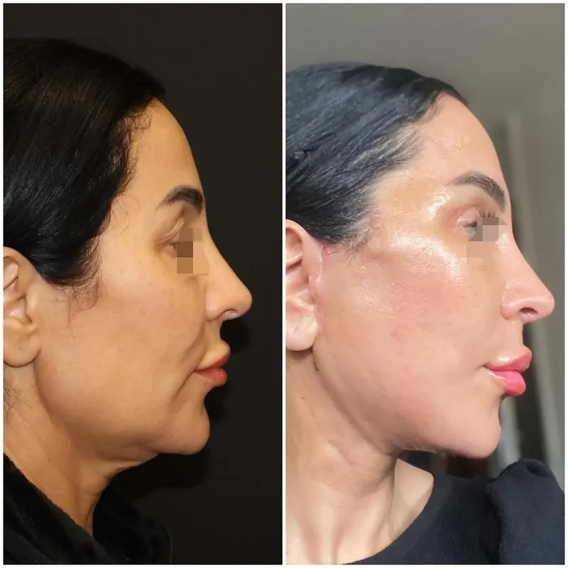 Before and after — Dr. Kayhan Zeytin