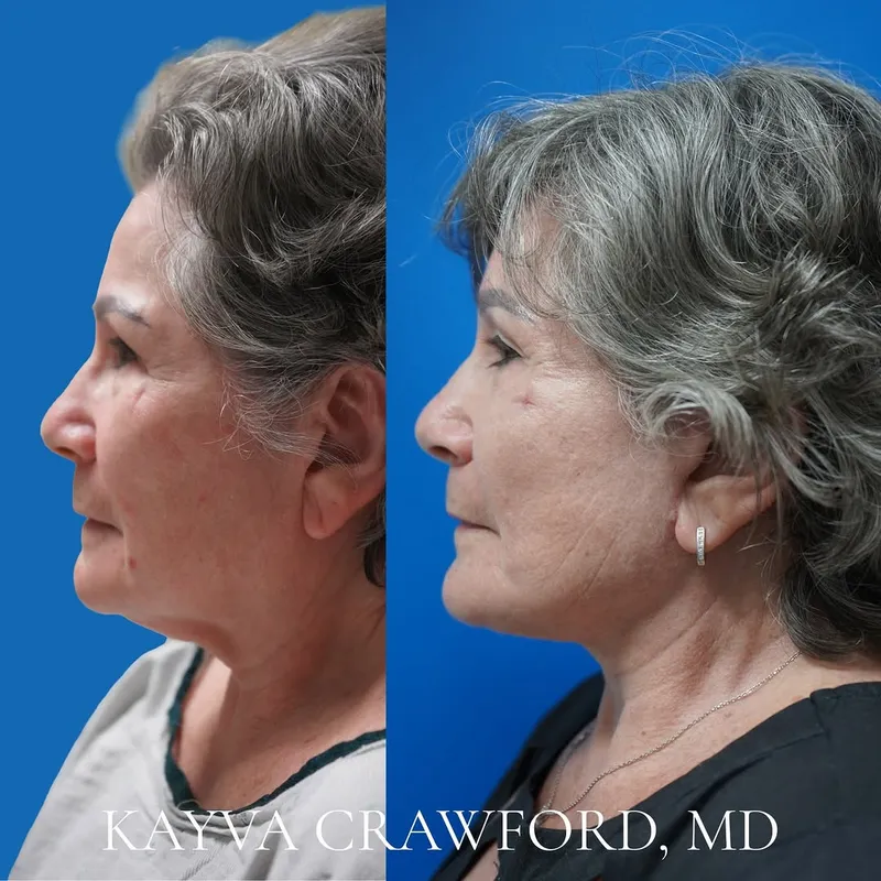 Before and after deep plane facelift — -1-year-old patient, frontal view by Dr. Kayva Crawford