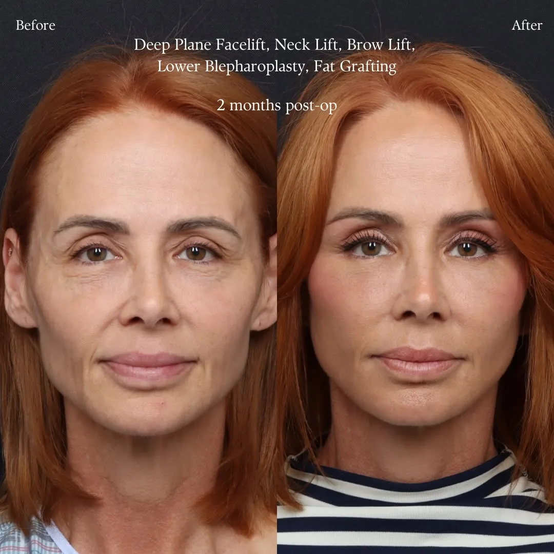 Before and after deep plane facelift — 52-year-old woman, frontal view, 2mo post-op by Dr. Keon Parsa