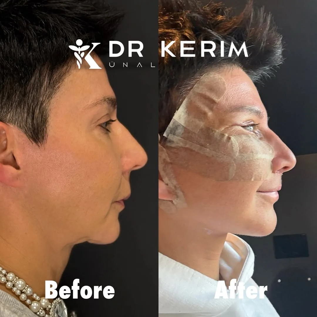 Before and after — Dr. Kerim Ünal