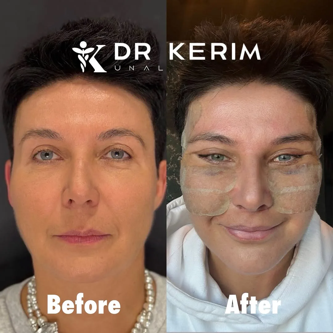 Before and after — Dr. Kerim Ünal