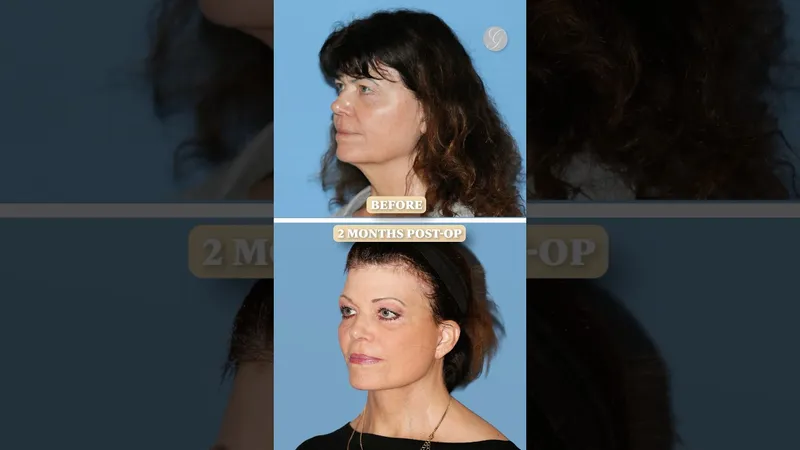 Before and after deep plane facelift, frontal view by Dr. Kevin Sadati