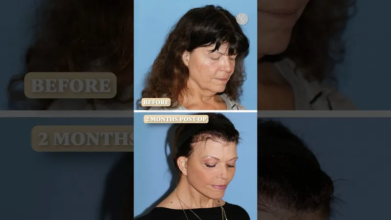Before and after deep plane facelift, frontal view by Dr. Kevin Sadati