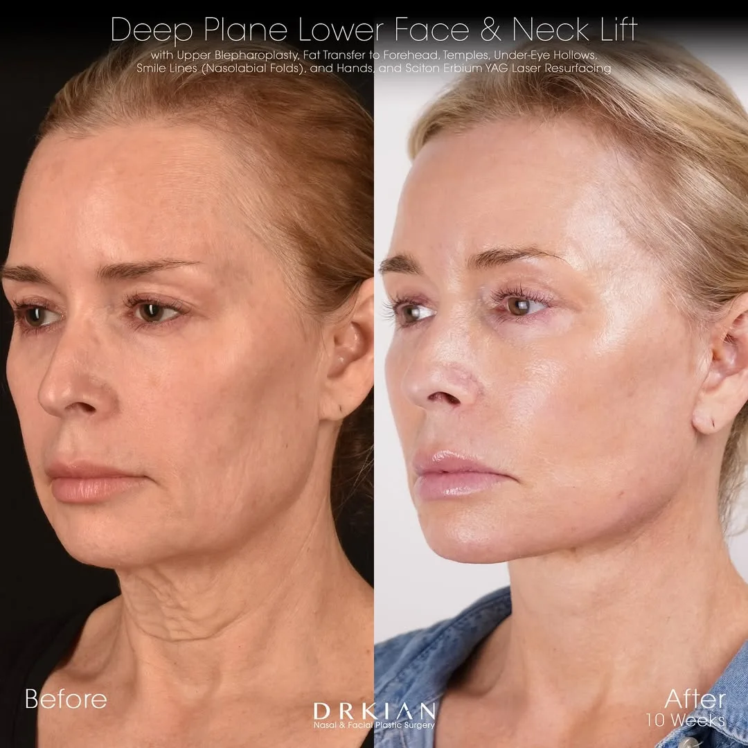 Before and after deep plane facelift — 52-year-old woman, oblique left view, 10mo post-op by Dr. Kian Karimi