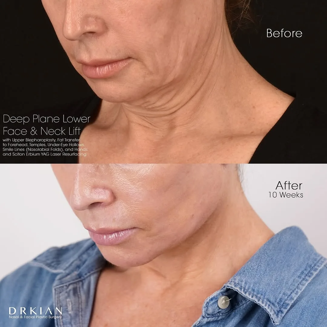 Before and after deep plane facelift — 58-year-old woman, oblique right view, 10mo post-op by Dr. Kian Karimi