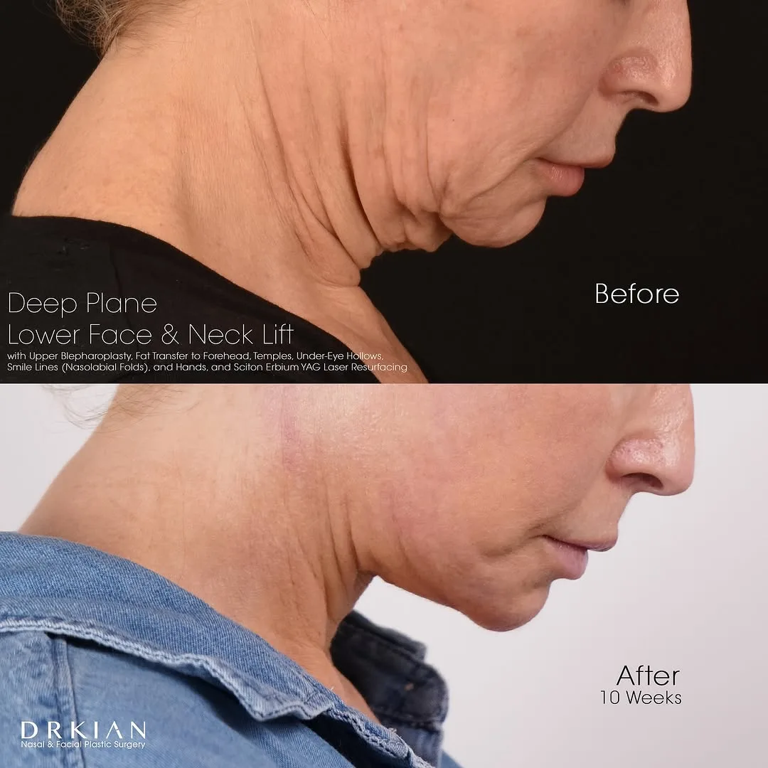 Before and after deep plane facelift — 58-year-old woman, right profile view, 2mo post-op by Dr. Kian Karimi