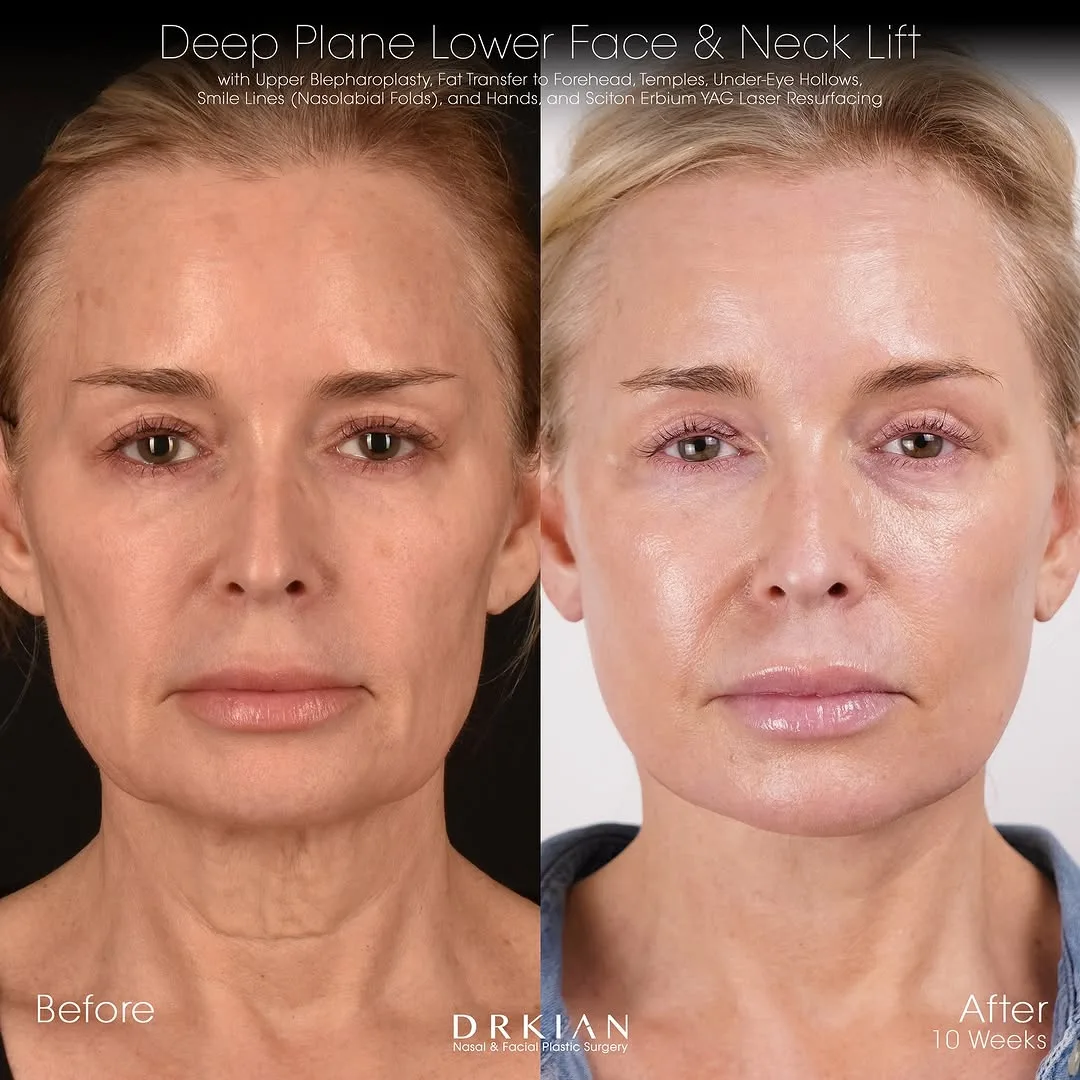 Before and after deep plane facelift — 58-year-old woman, frontal view, 3mo post-op by Dr. Kian Karimi