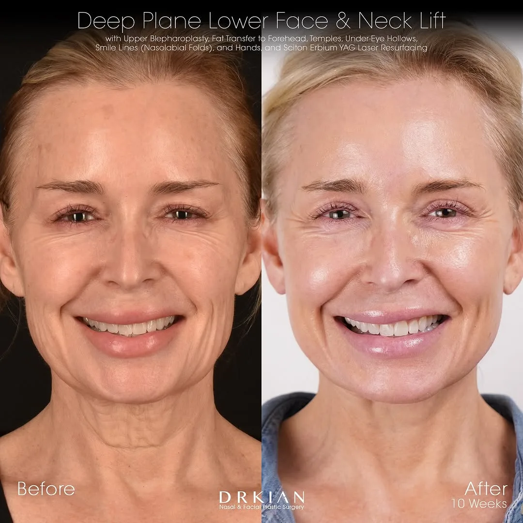 Before and after deep plane facelift — 52-year-old woman, frontal view, 3mo post-op by Dr. Kian Karimi
