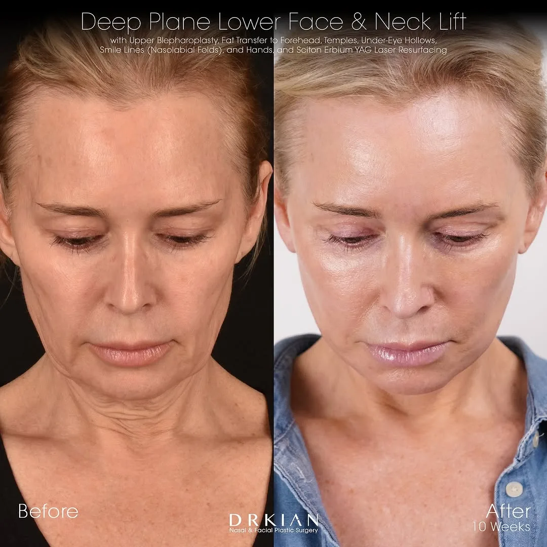 Before and after deep plane facelift — 55-year-old woman, frontal view, 2mo post-op by Dr. Kian Karimi