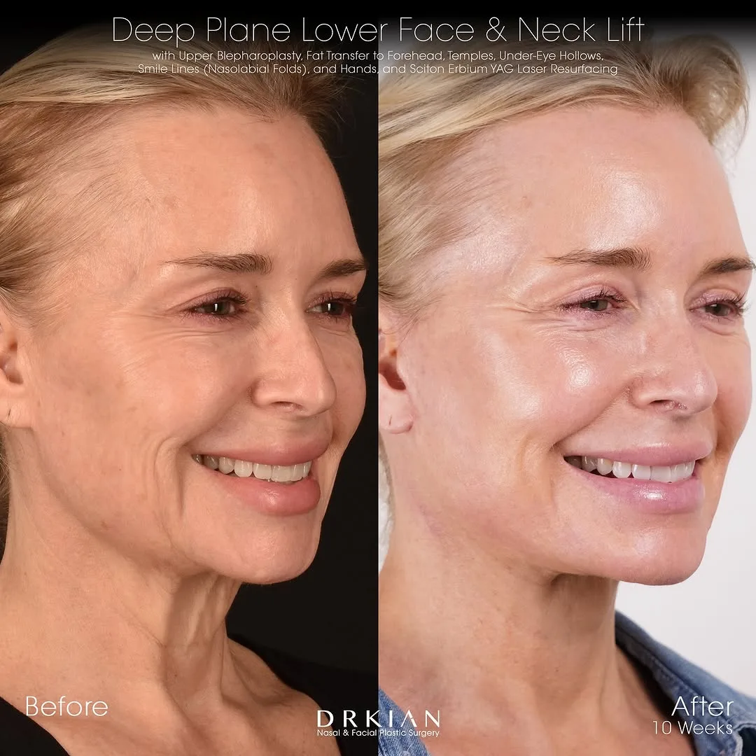 Before and after deep plane facelift — 52-year-old woman, oblique right view, 2mo post-op by Dr. Kian Karimi