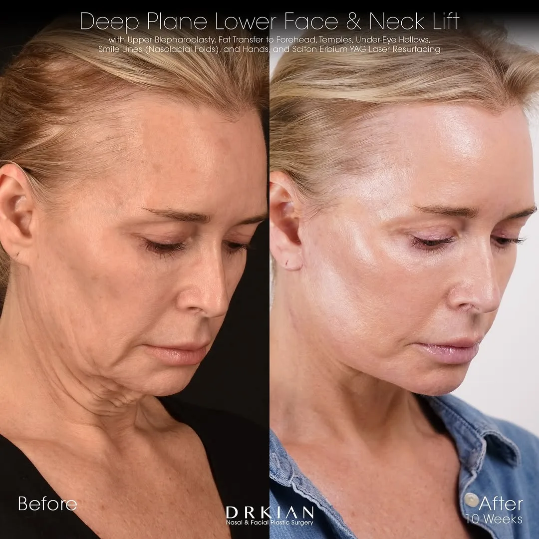 Before and after deep plane facelift — 55-year-old woman, left profile view, 2mo post-op by Dr. Kian Karimi