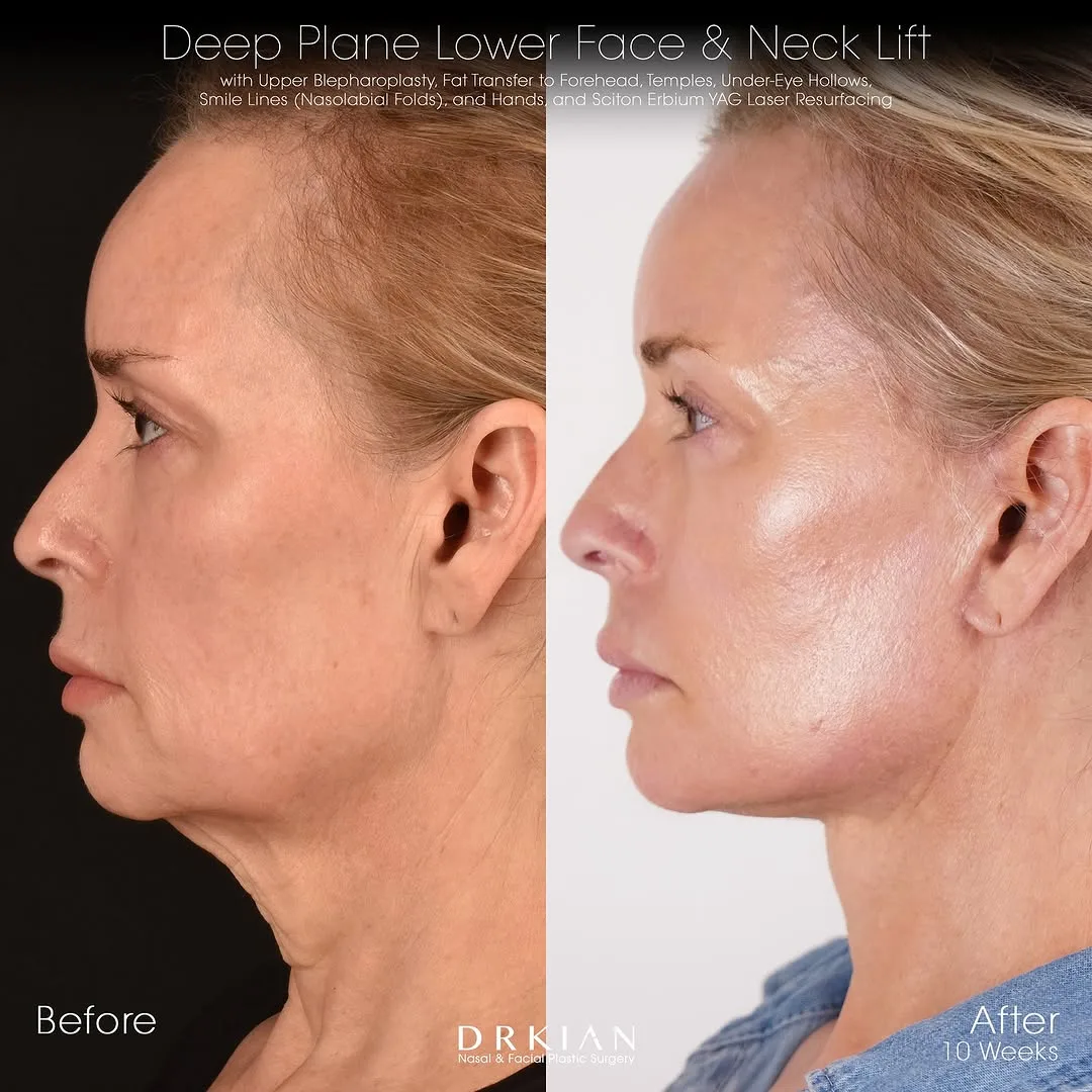 Before and after deep plane facelift — 55-year-old woman, left profile view, 3mo post-op by Dr. Kian Karimi