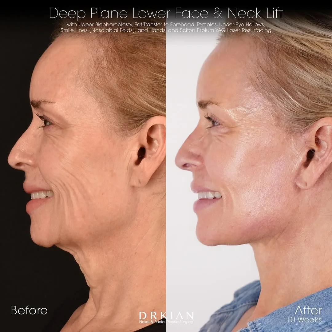 Before and after deep plane facelift — 58-year-old woman, right profile view, 2mo post-op by Dr. Kian Karimi