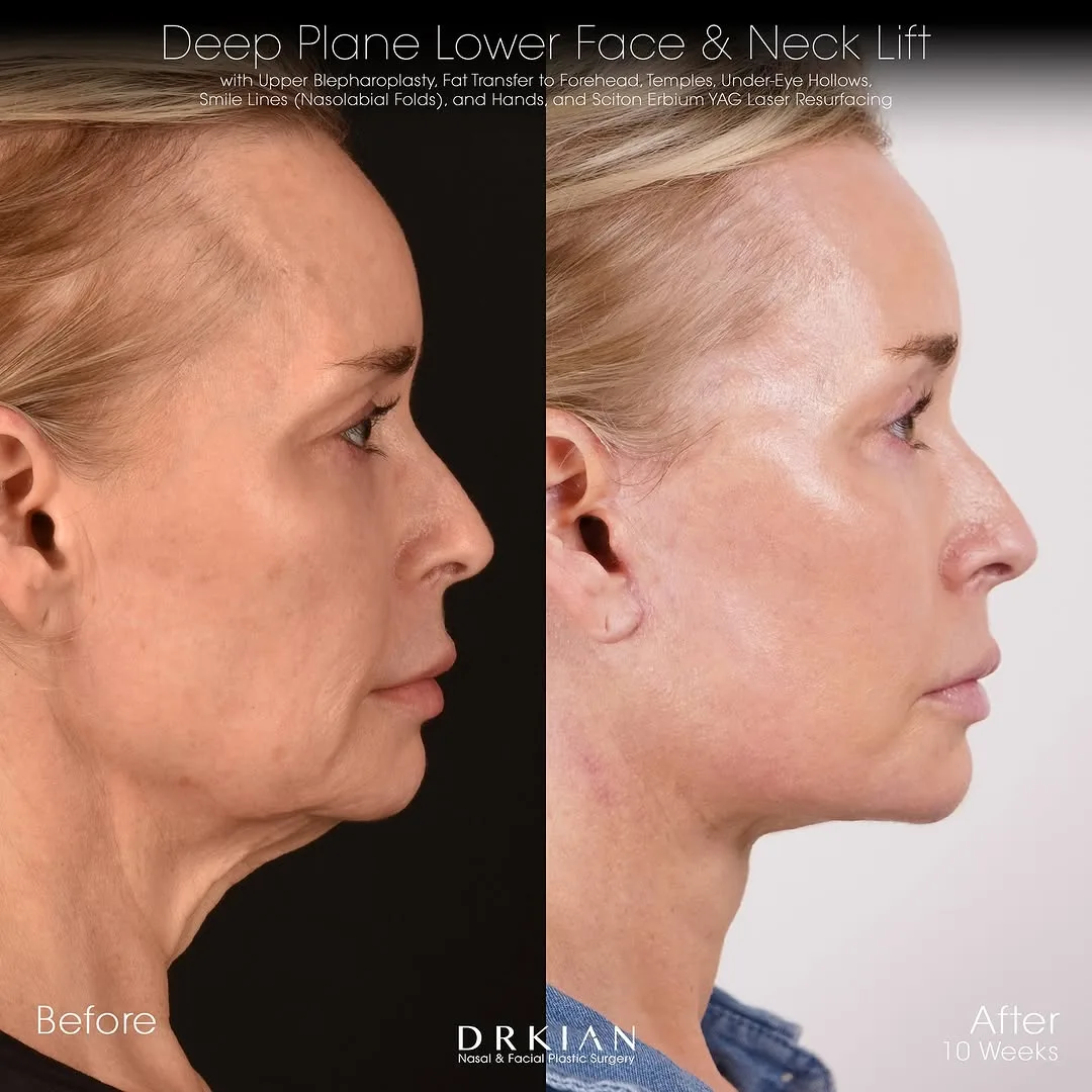 Before and after deep plane facelift — 55-year-old woman, right profile view, 2mo post-op by Dr. Kian Karimi