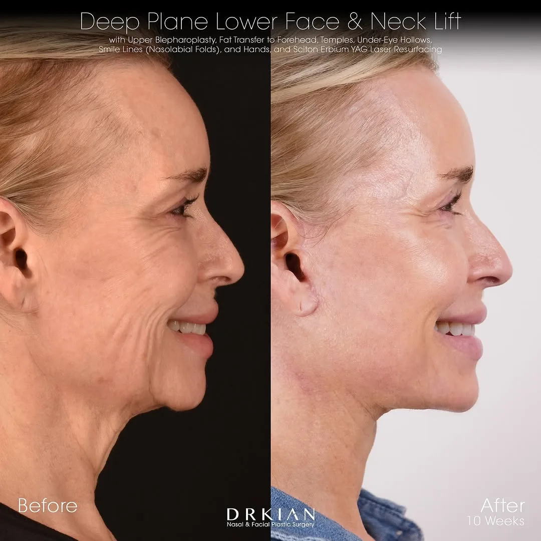 Before and after deep plane facelift — 58-year-old woman, left profile view, 2mo post-op by Dr. Kian Karimi