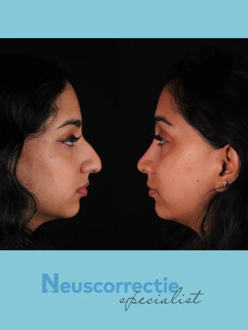 Before and after — Dr. Koen Ingels