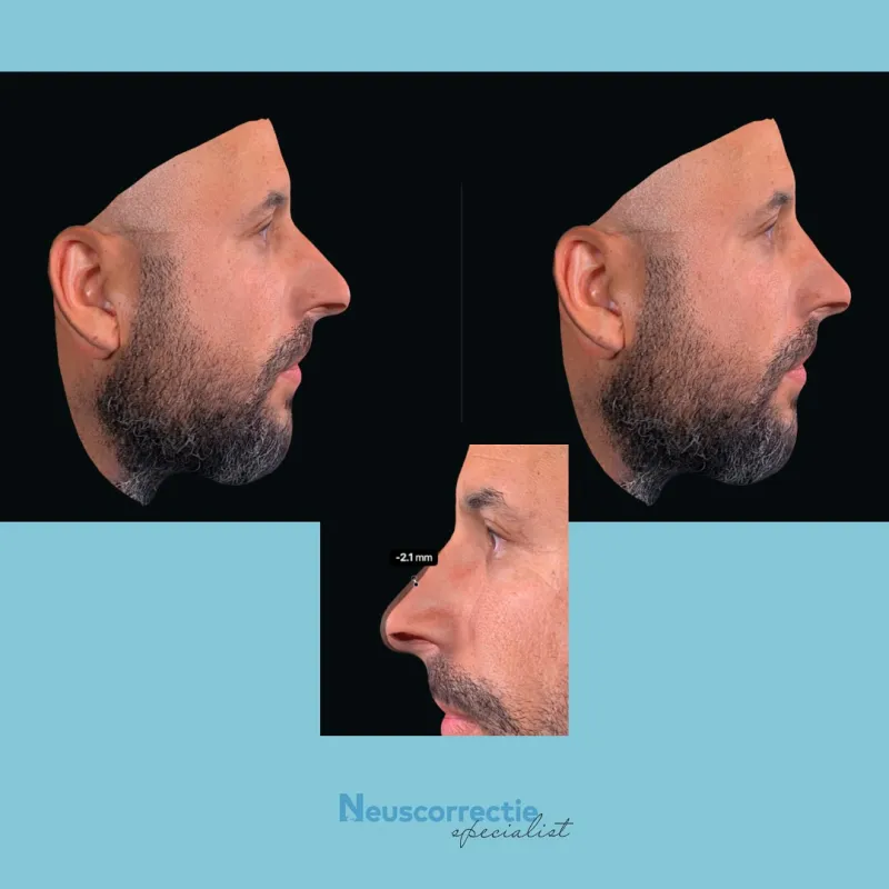 Before and after — Dr. Koen Ingels