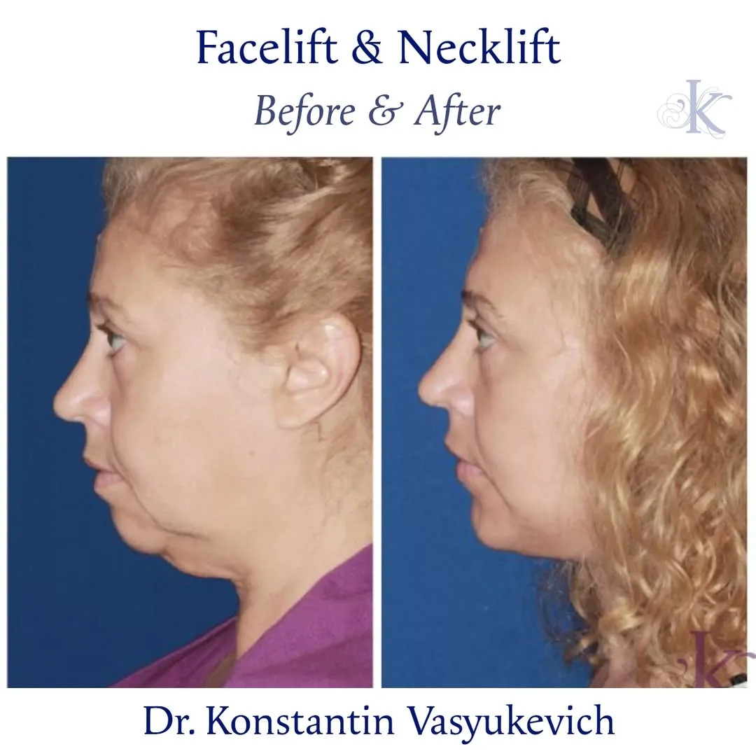 Before and after deep plane facelift — 48-year-old woman, left profile view, 12mo post-op by Dr. Konstantin Vasyukevich