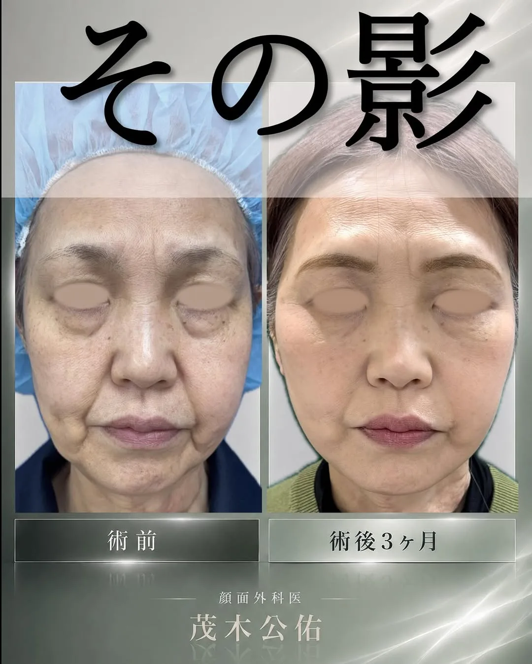 Before and after — Dr. Kousuke Mogi