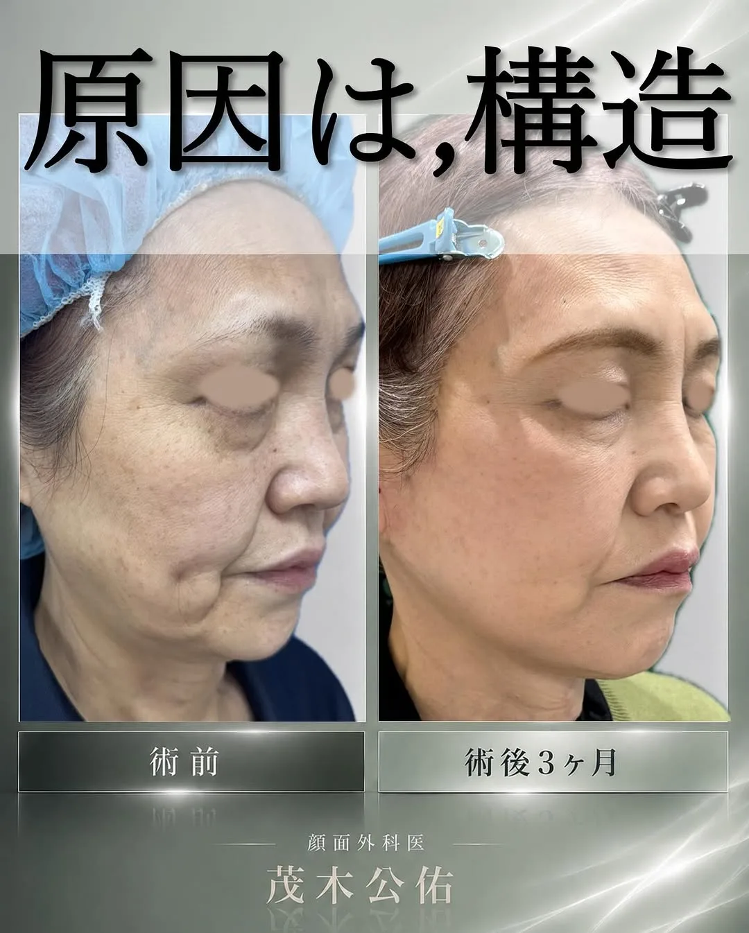 Before and after — Dr. Kousuke Mogi
