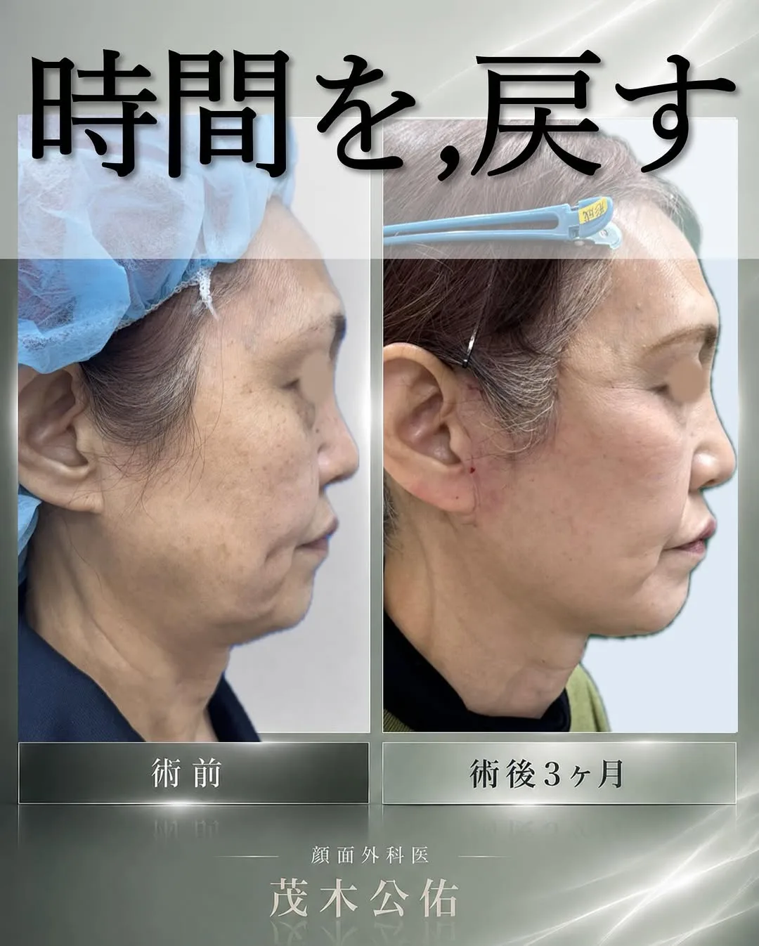 Before and after — Dr. Kousuke Mogi
