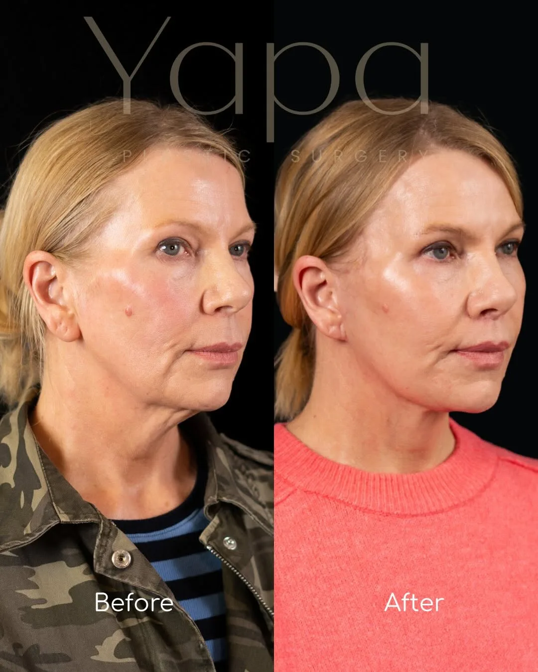 Before and after deep plane facelift — 55-year-old woman, three-quarter view, 2mo post-op by Dr. Kshem Yapa