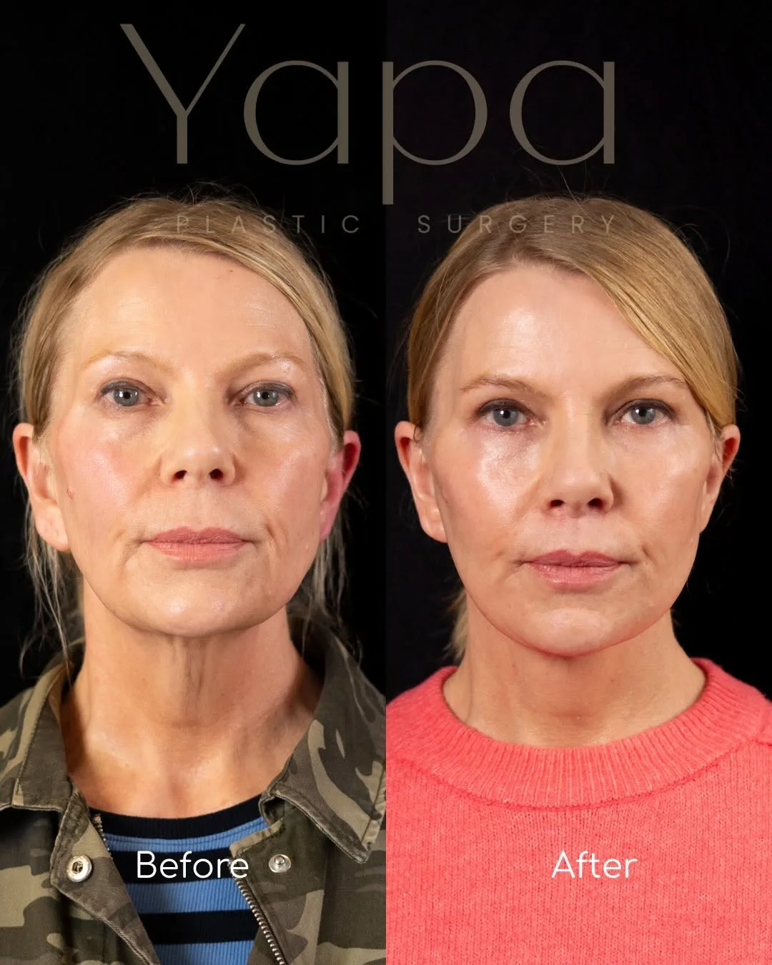Before and after deep plane facelift — 52-year-old woman, frontal view, 2mo post-op by Dr. Kshem Yapa