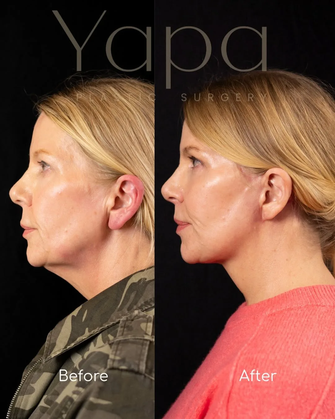 Before and after deep plane facelift — 52-year-old woman, left profile view, 2mo post-op by Dr. Kshem Yapa