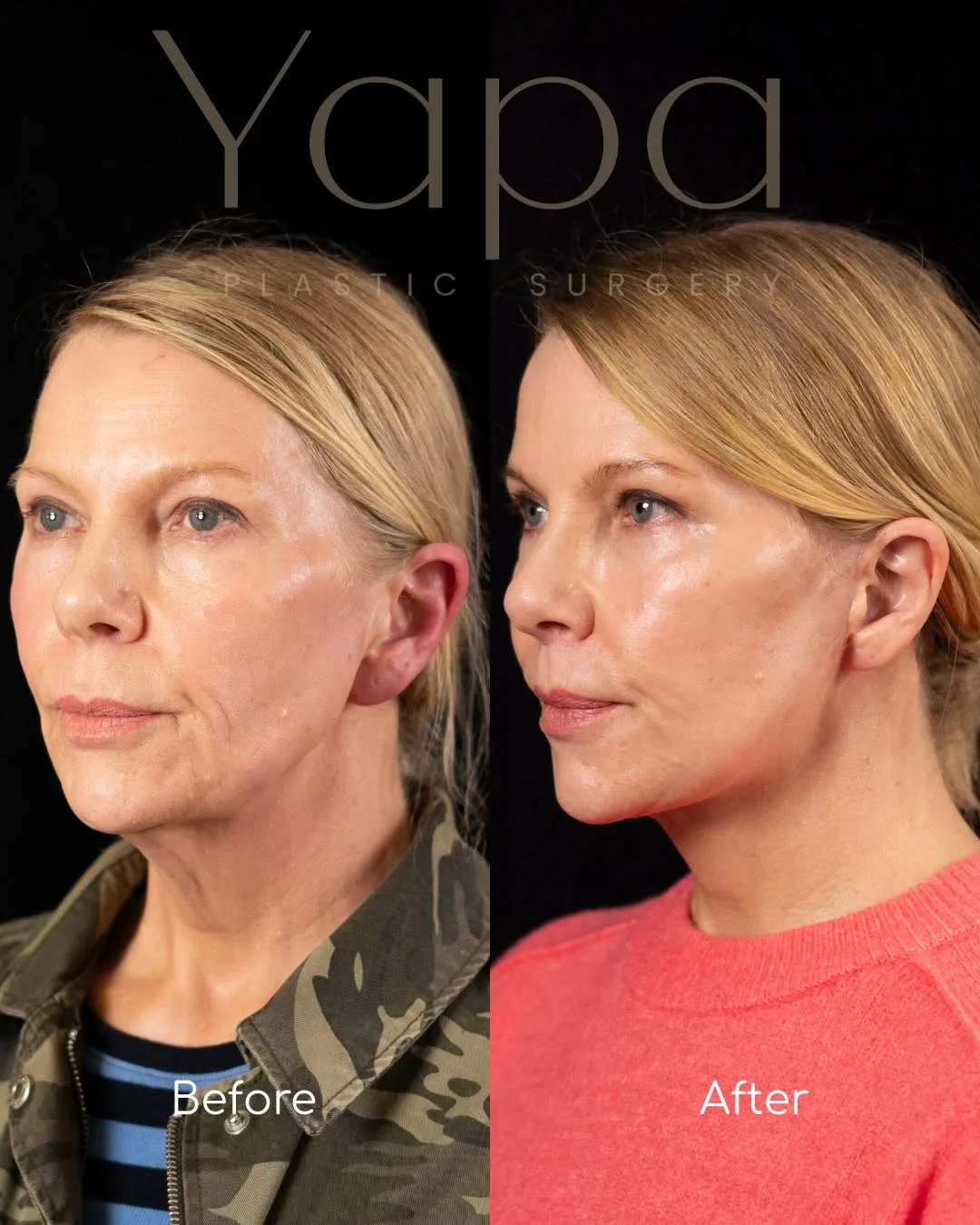 Before and after deep plane facelift — 52-year-old woman, three-quarter view, 2mo post-op by Dr. Kshem Yapa