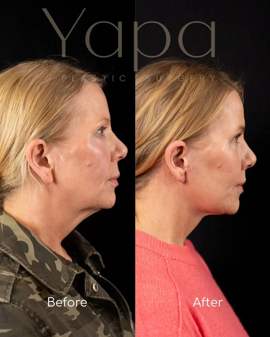 Before and after deep plane facelift — 55-year-old woman, right profile view, 2mo post-op by Dr. Kshem Yapa