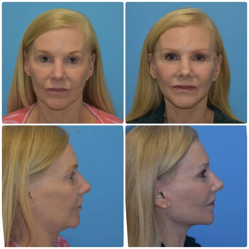 Before and after deep plane facelift — -1-year-old patient, frontal view by Dr. Kyle Choe
