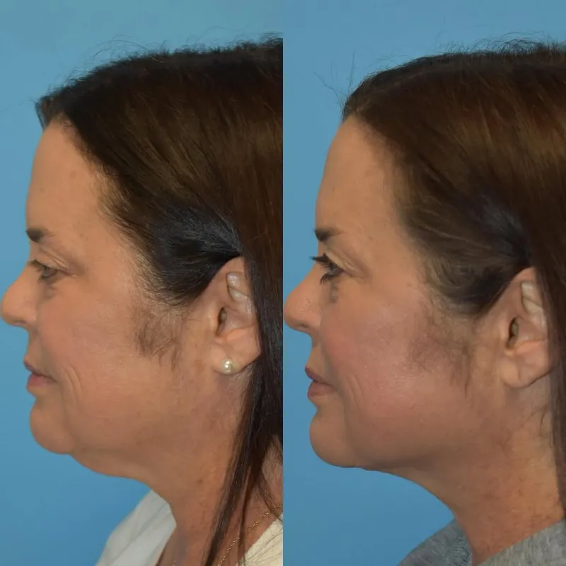 Before and after deep plane facelift — -1-year-old patient, frontal view by Dr. Kyle Choe