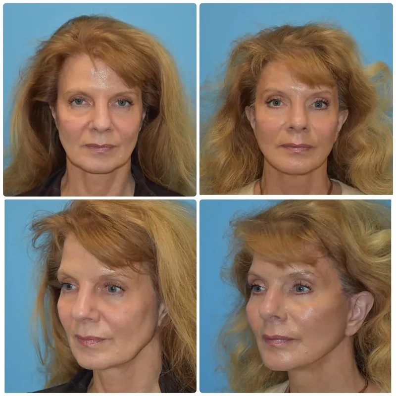 Before and after deep plane facelift — -1-year-old patient, frontal view by Dr. Kyle Choe