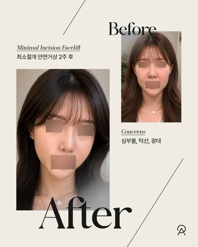 Before and after: Dr. Kyung-chan Ahn