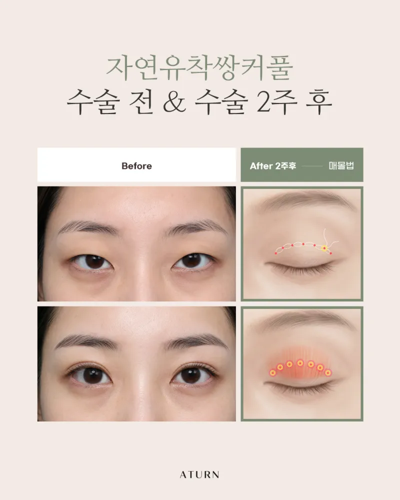 Before and after: Dr. Kyung-chan Ahn