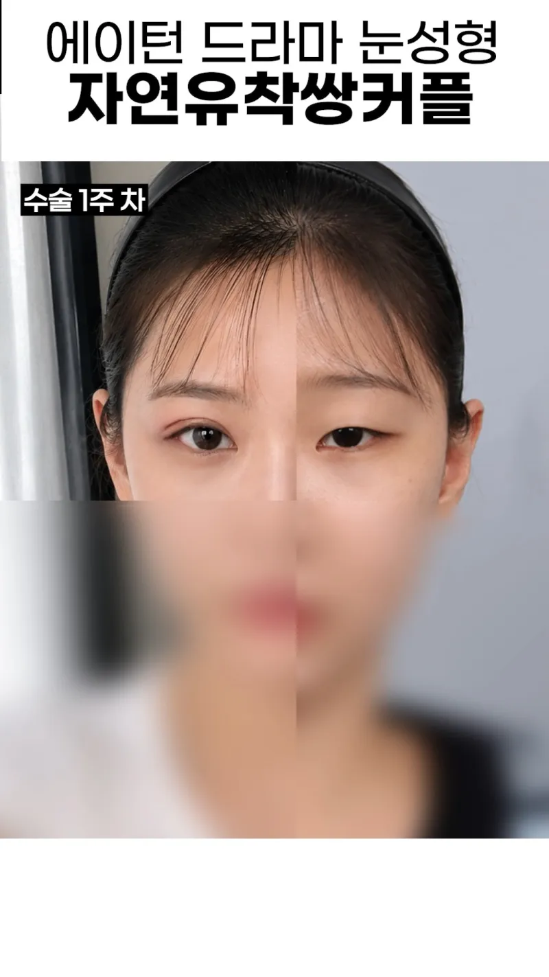 Before and after: Dr. Kyung-chan Ahn