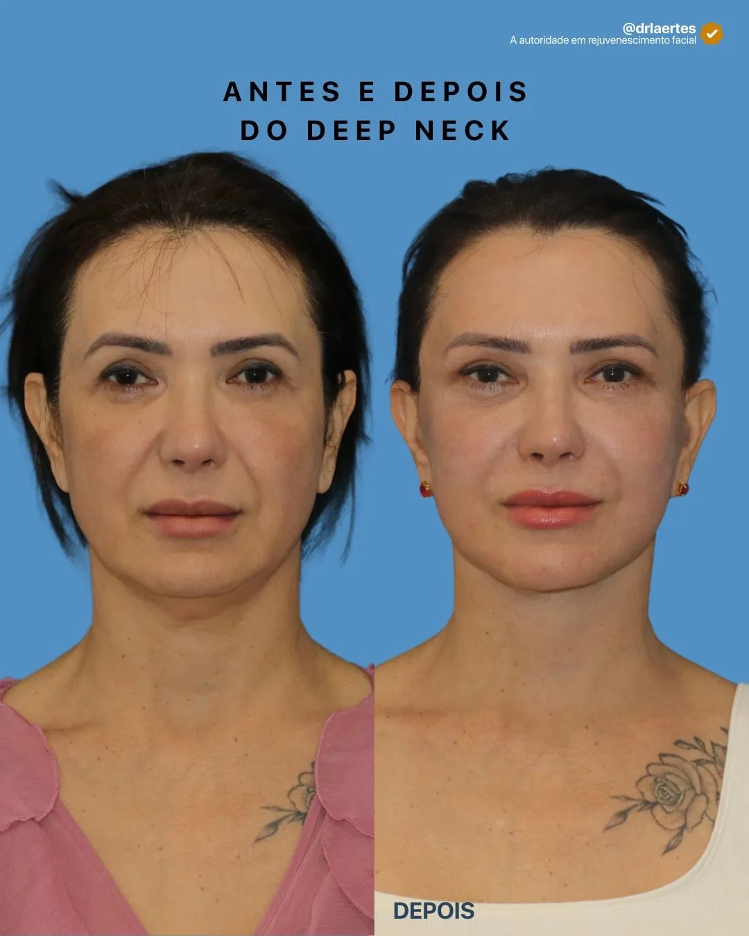 Before and after deep plane facelift — 48-year-old woman, frontal view, 6mo post-op by Dr. Laertes Thomaz Jr