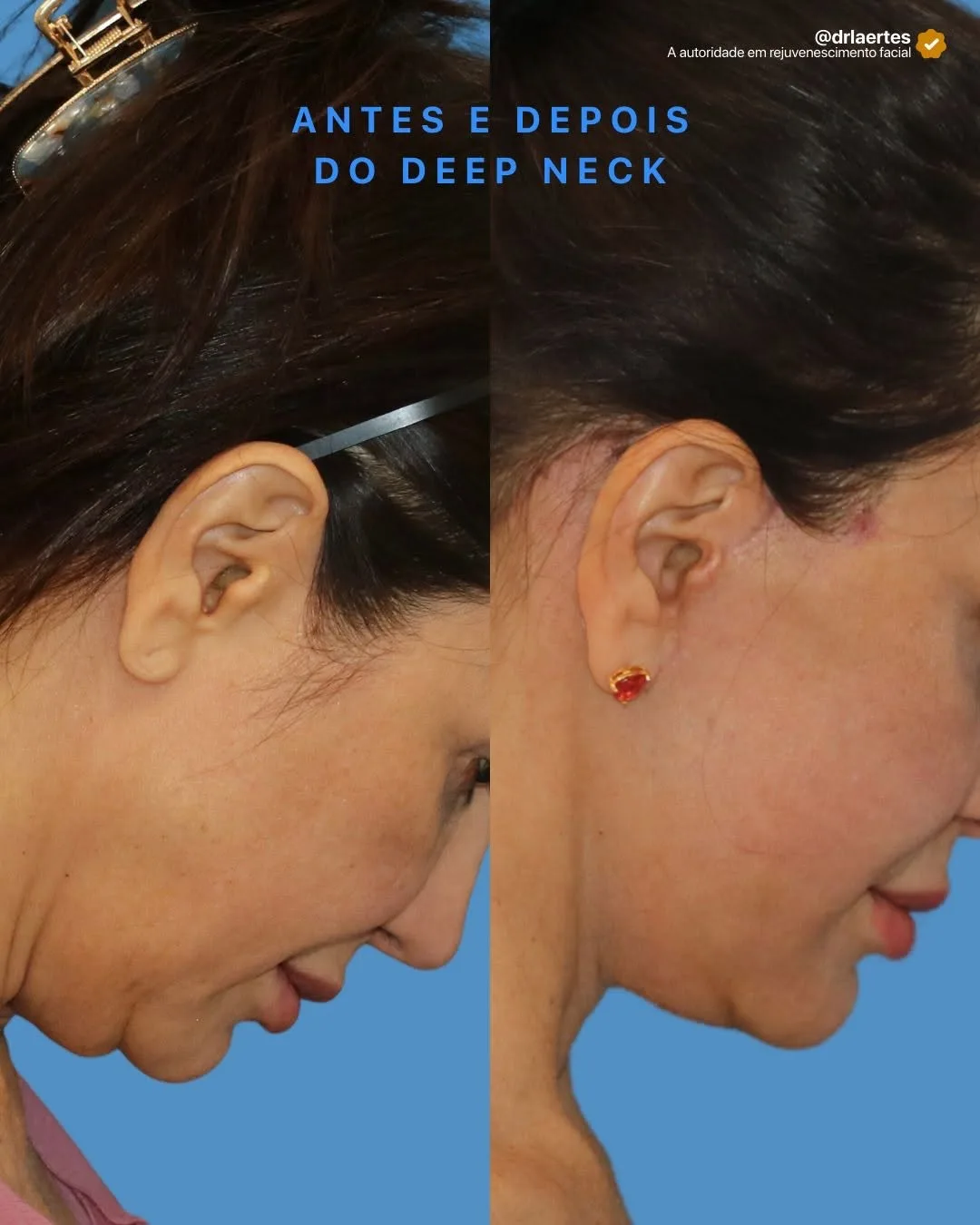 Before and after deep plane facelift — 45-year-old woman, right profile view, 6mo post-op by Dr. Laertes Thomaz Jr