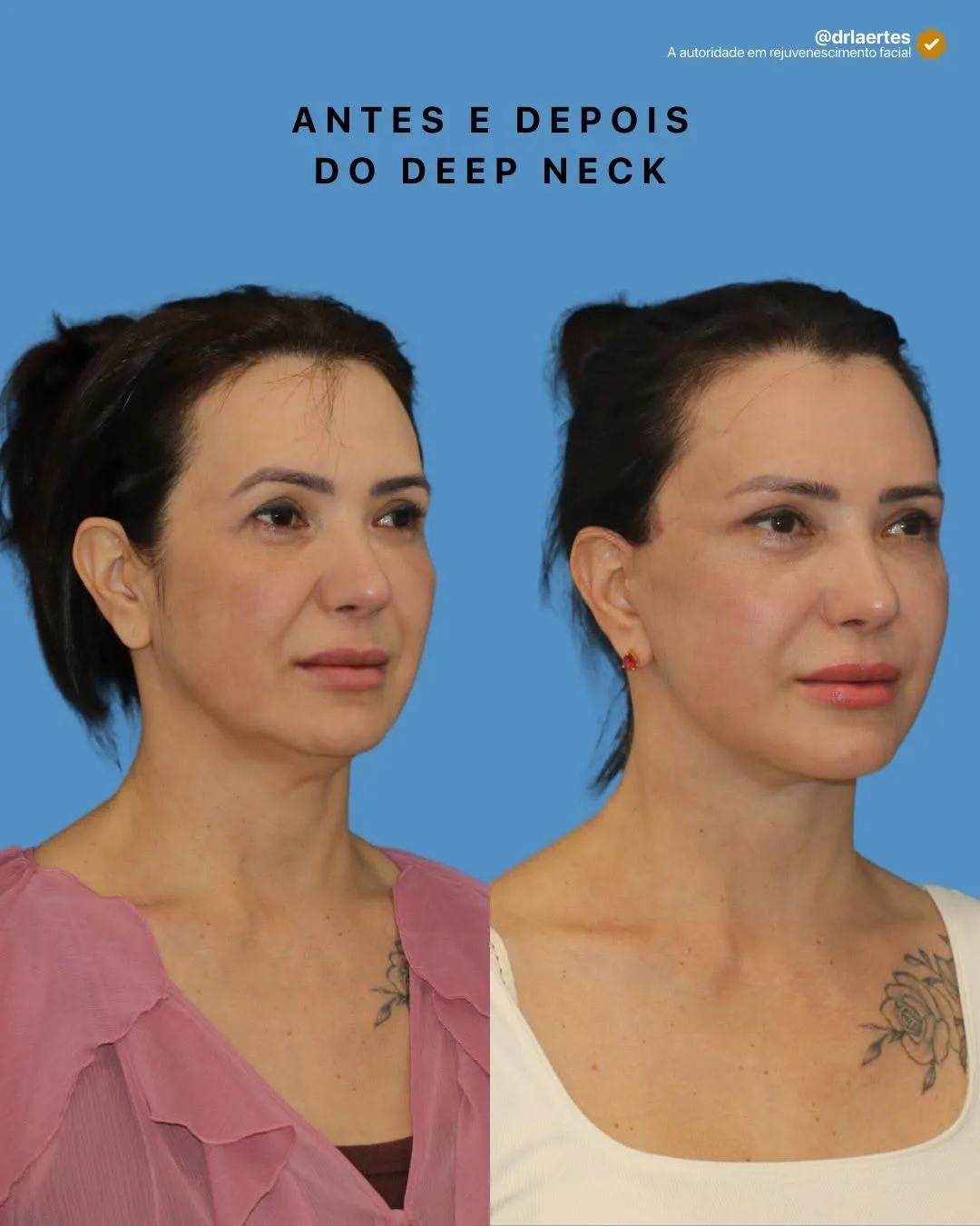 Before and after deep plane facelift — 45-year-old woman, oblique right view, 6mo post-op by Dr. Laertes Thomaz Jr