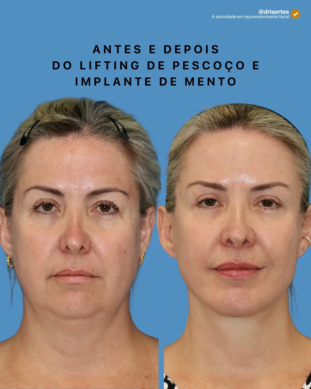 Before and after deep plane facelift — 55-year-old woman, frontal view, 7mo post-op by Dr. Laertes Thomaz Jr