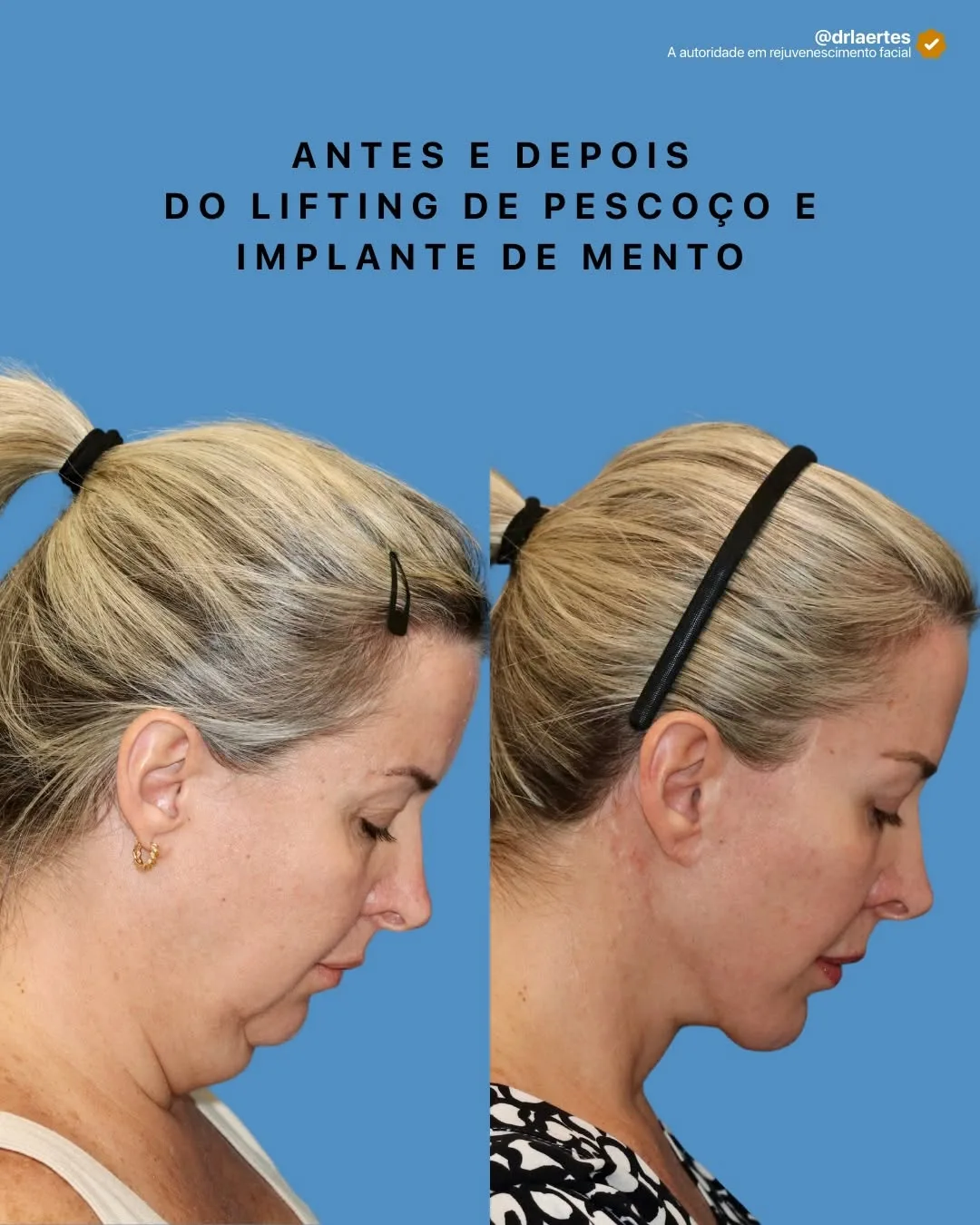 Before and after deep plane facelift — 45-year-old woman, right profile view, 6mo post-op by Dr. Laertes Thomaz Jr