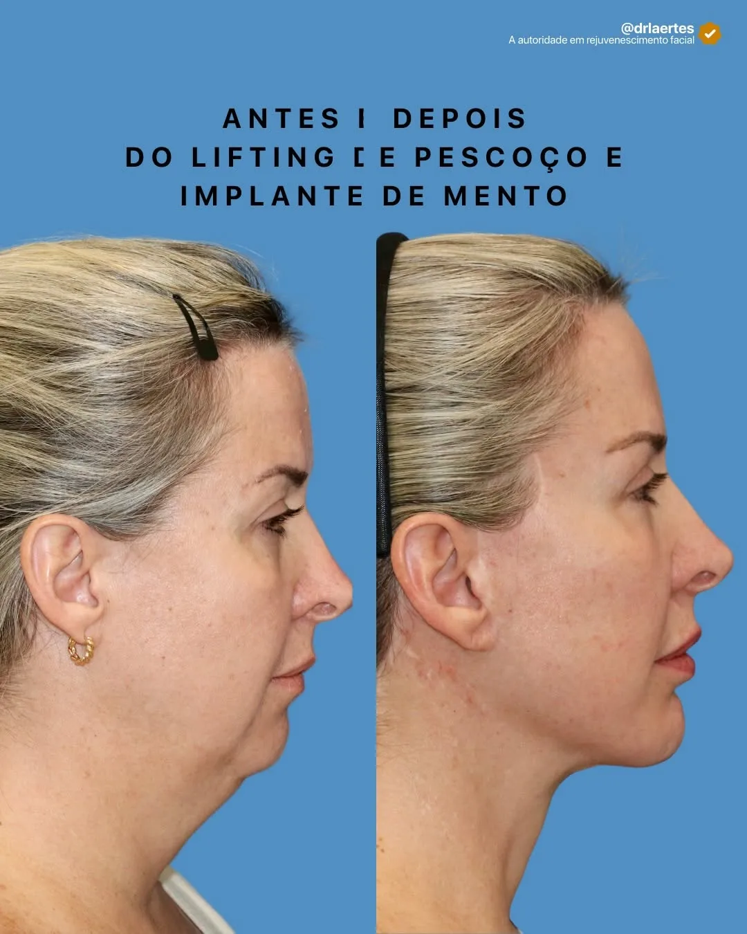 Before and after deep plane facelift — 55-year-old woman, right profile view, 7mo post-op by Dr. Laertes Thomaz Jr