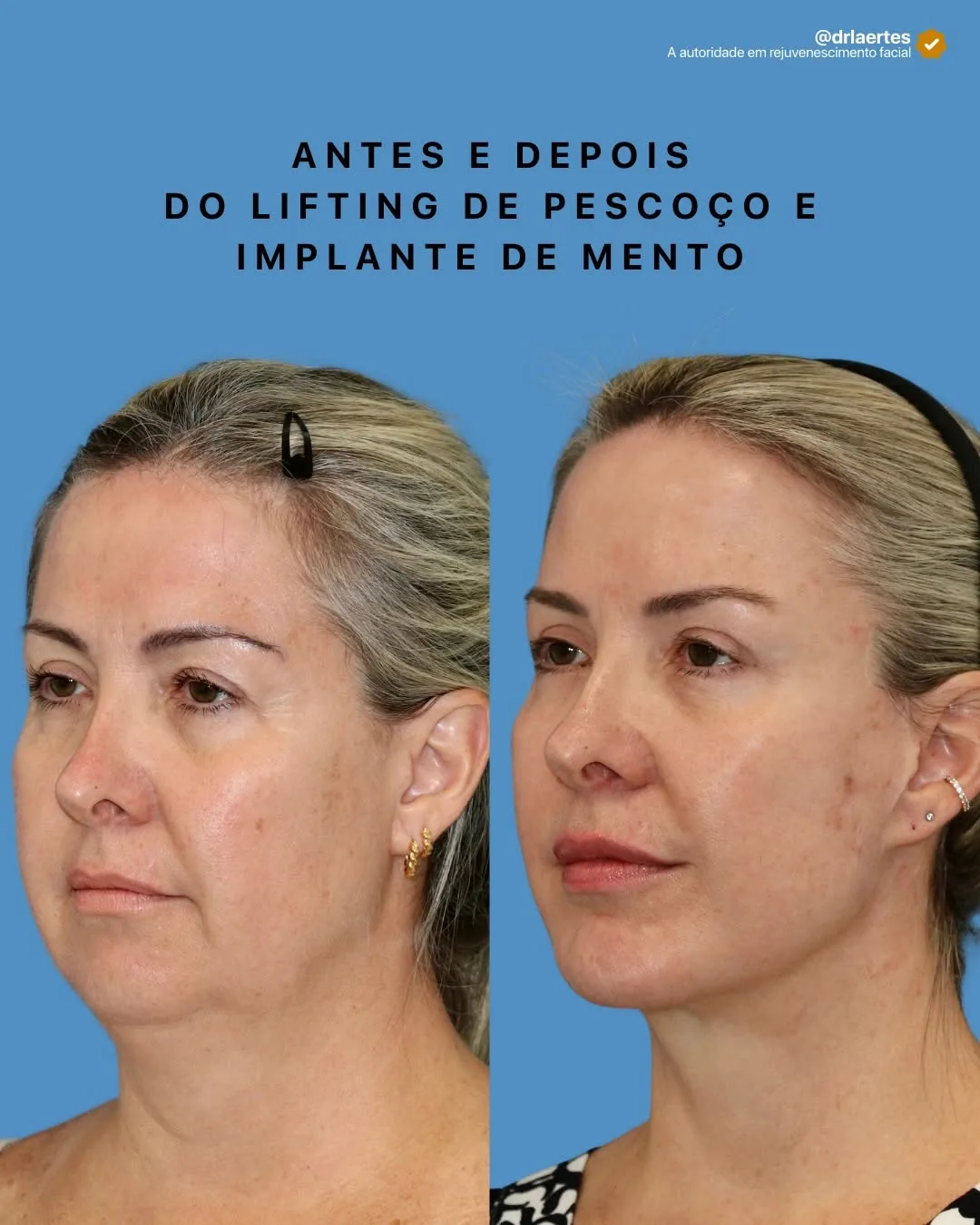 Before and after deep plane facelift — 55-year-old woman, oblique left view, 7mo post-op by Dr. Laertes Thomaz Jr