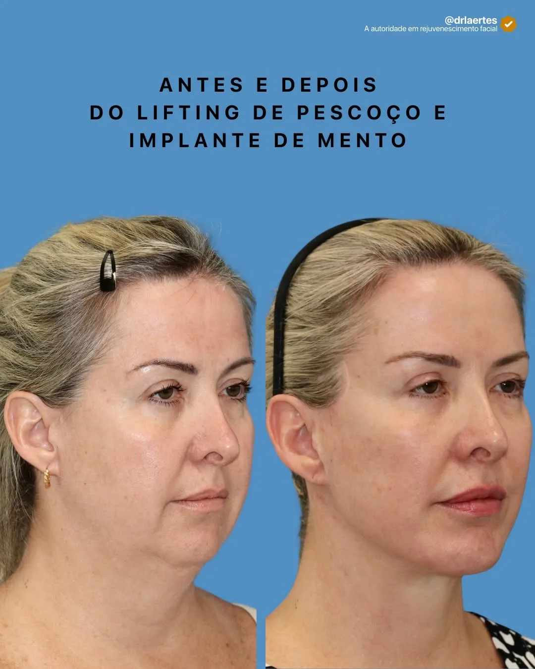 Before and after deep plane facelift — 55-year-old woman, oblique right view, 7mo post-op by Dr. Laertes Thomaz Jr